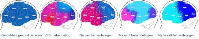 Hersenscan effect EFT
